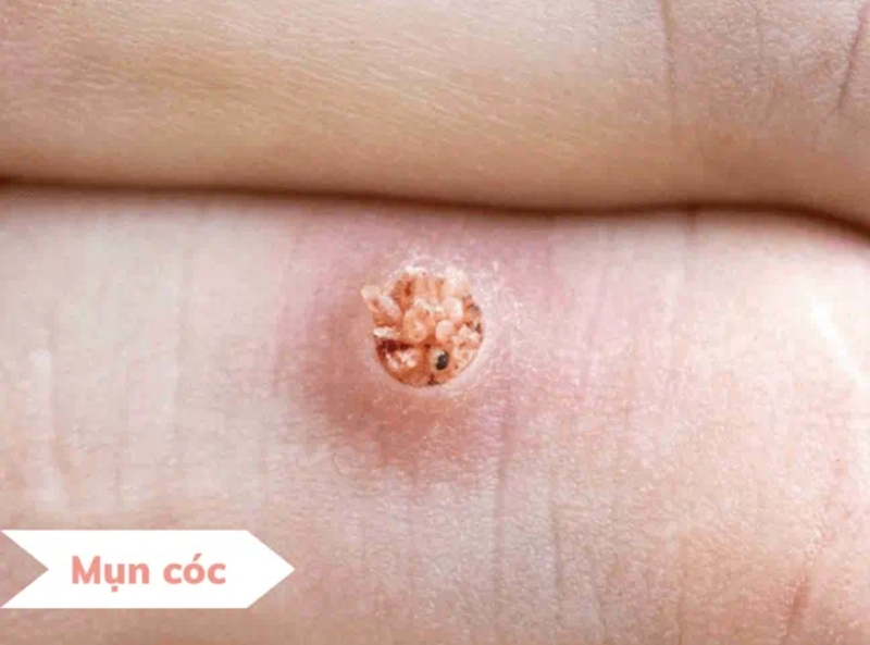 Các dấu hiệu phổ biến của mụn cóc như bề mặt sần, chấm đen nhỏ và mọc thành cụm. 