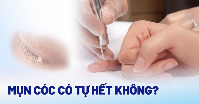 Một số mụn cóc có thể tự khỏi, nhưng cần theo dõi kỹ để tránh lan rộng hoặc nhiễm trùng. 