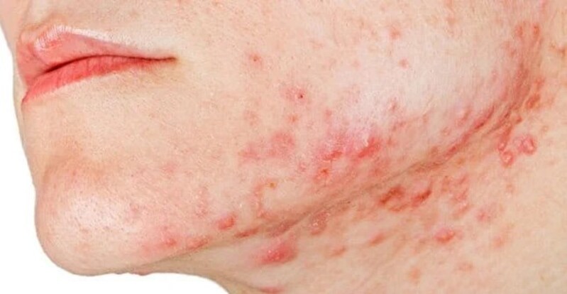 Uống gì để trị mụn nội tiết hiệu quả? Đồ uống giúp da sáng khỏe